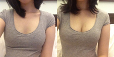 Upbra before and after