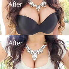 Upbra before and after