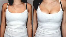 Upbra before and after